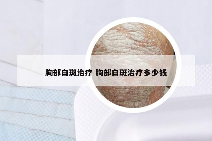 胸部白斑治疗 胸部白斑治疗多少钱