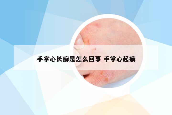手掌心长癣是怎么回事 手掌心起癣