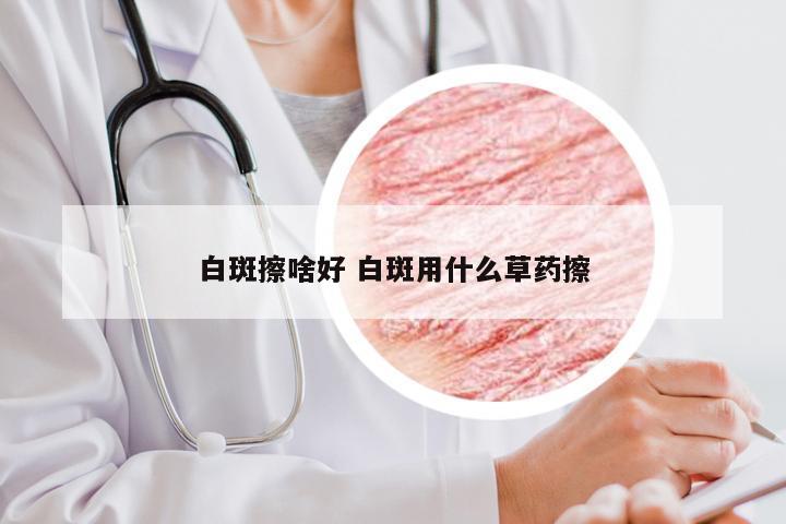 白斑擦啥好 白斑用什么草药擦
