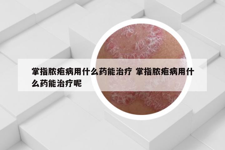 掌指脓疱病用什么药能治疗 掌指脓疱病用什么药能治疗呢