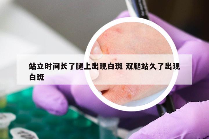 站立时间长了腿上出现白斑 双腿站久了出现白斑