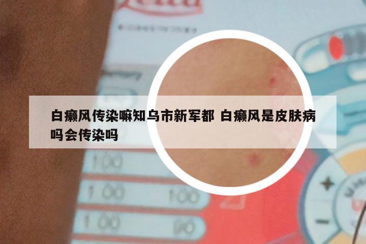 白癞风传染嘛知乌市新军都 白癞风是皮肤病吗会传染吗