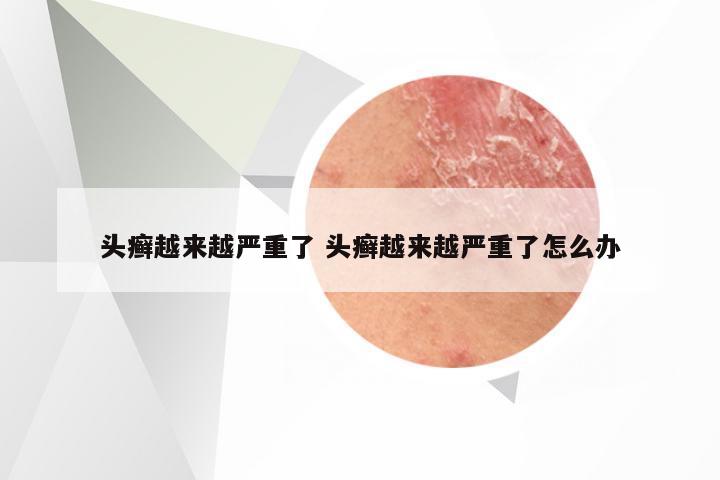 头癣越来越严重了 头癣越来越严重了怎么办