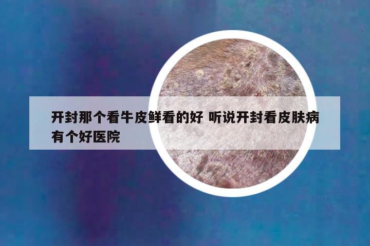开封那个看牛皮鲜看的好 听说开封看皮肤病有个好医院