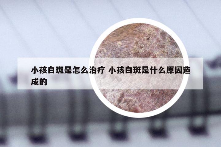 小孩白斑是怎么治疗 小孩白斑是什么原因造成的