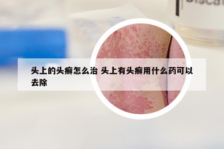 头上的头癣怎么治 头上有头癣用什么药可以去除