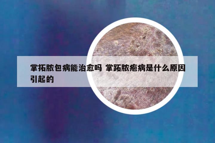 掌拓脓包病能治愈吗 掌跖脓疱病是什么原因引起的