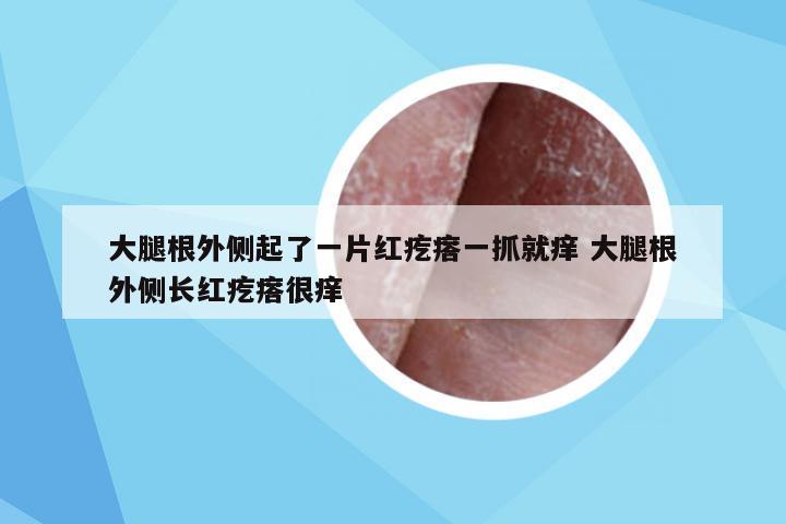 大腿根外侧起了一片红疙瘩一抓就痒 大腿根外侧长红疙瘩很痒