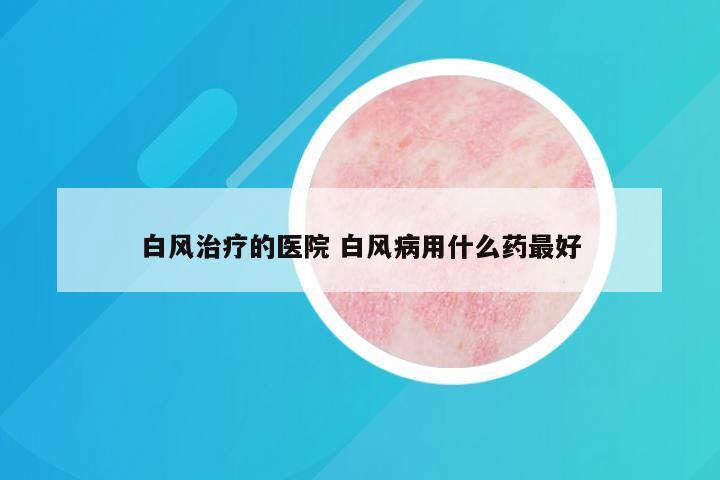 白风治疗的医院 白风病用什么药最好