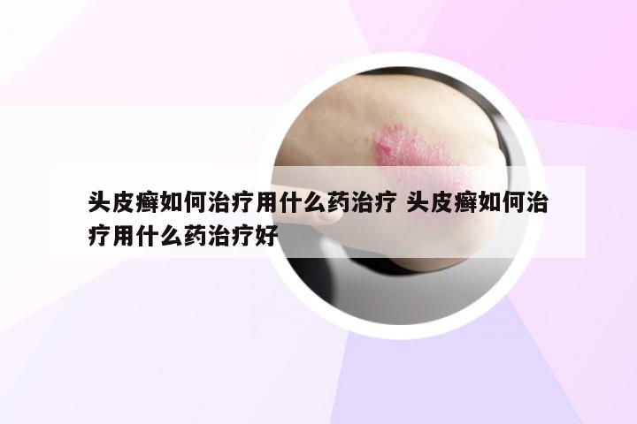 头皮癣如何治疗用什么药治疗 头皮癣如何治疗用什么药治疗好