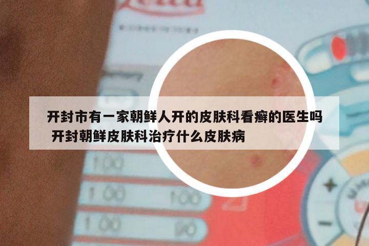 开封市有一家朝鲜人开的皮肤科看癣的医生吗 开封朝鲜皮肤科治疗什么皮肤病