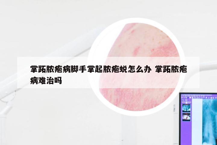 掌跖脓疱病脚手掌起脓疱蜕怎么办 掌跖脓疱病难治吗