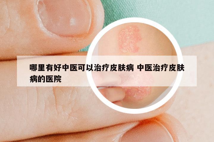 哪里有好中医可以治疗皮肤病 中医治疗皮肤病的医院