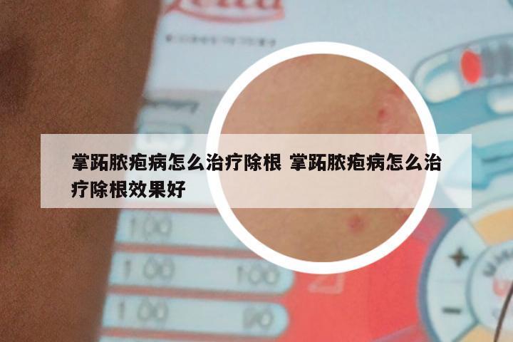 掌跖脓疱病怎么治疗除根 掌跖脓疱病怎么治疗除根效果好