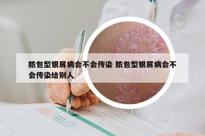 脓包型银屑病会不会传染 脓包型银屑病会不会传染给别人