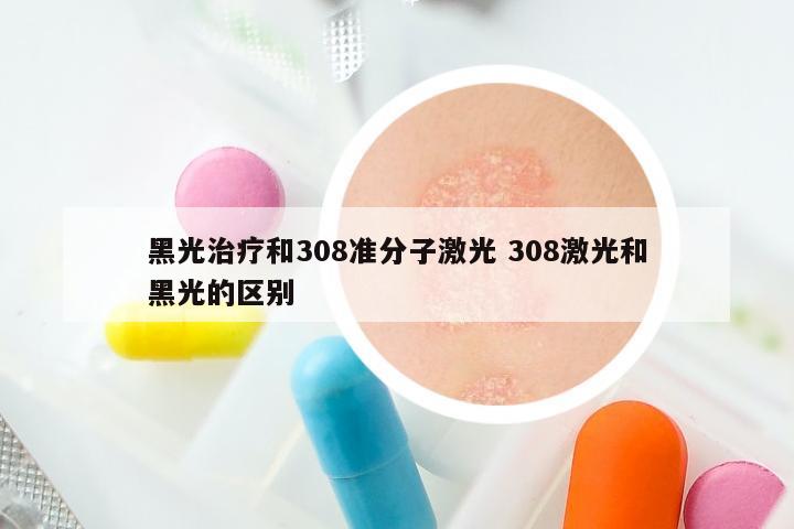 黑光治疗和308准分子激光 308激光和黑光的区别