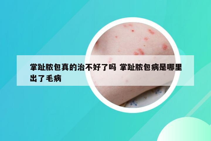 掌趾脓包真的治不好了吗 掌趾脓包病是哪里出了毛病