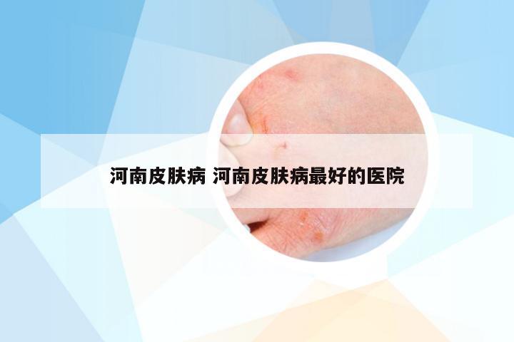 河南皮肤病 河南皮肤病最好的医院