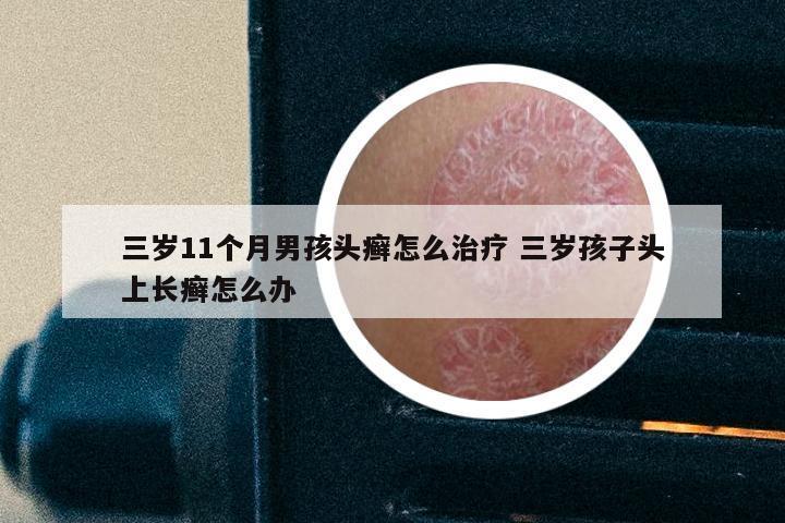 三岁11个月男孩头癣怎么治疗 三岁孩子头上长癣怎么办