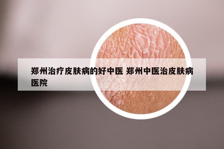 郑州治疗皮肤病的好中医 郑州中医治皮肤病医院