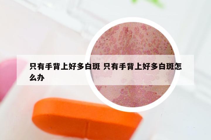 只有手背上好多白斑 只有手背上好多白斑怎么办