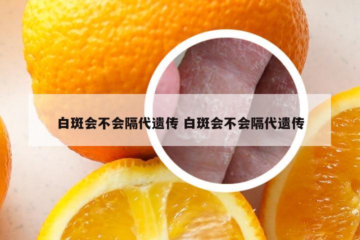 白斑会不会隔代遗传 白斑会不会隔代遗传