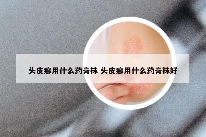 头皮癣用什么药膏抹 头皮癣用什么药膏抹好