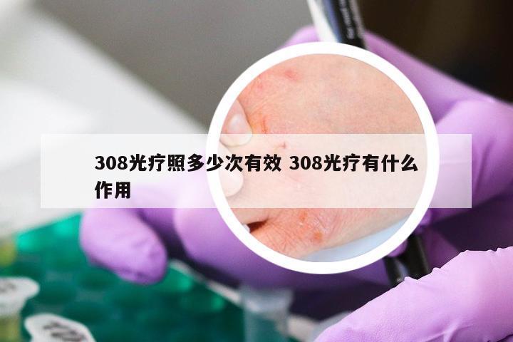 308光疗照多少次有效 308光疗有什么作用