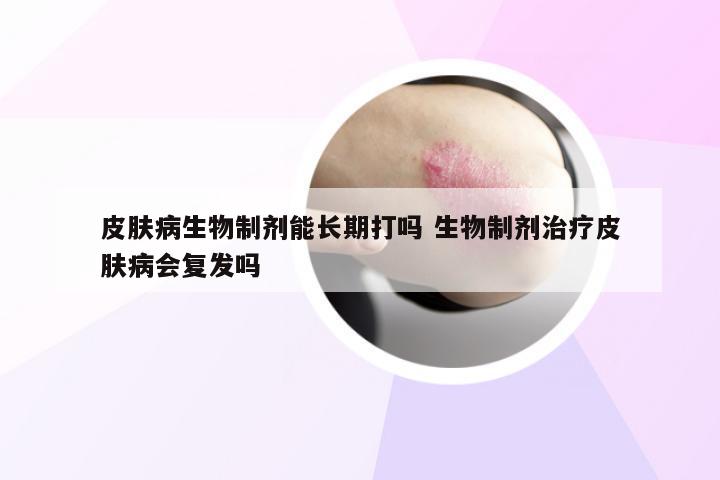 皮肤病生物制剂能长期打吗 生物制剂治疗皮肤病会复发吗