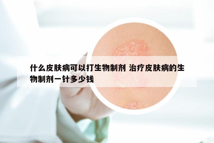 什么皮肤病可以打生物制剂 治疗皮肤病的生物制剂一针多少钱