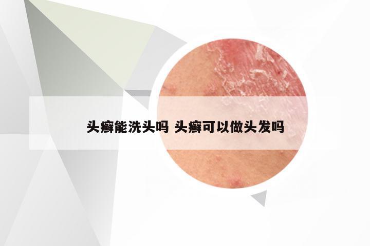 头癣能洗头吗 头癣可以做头发吗