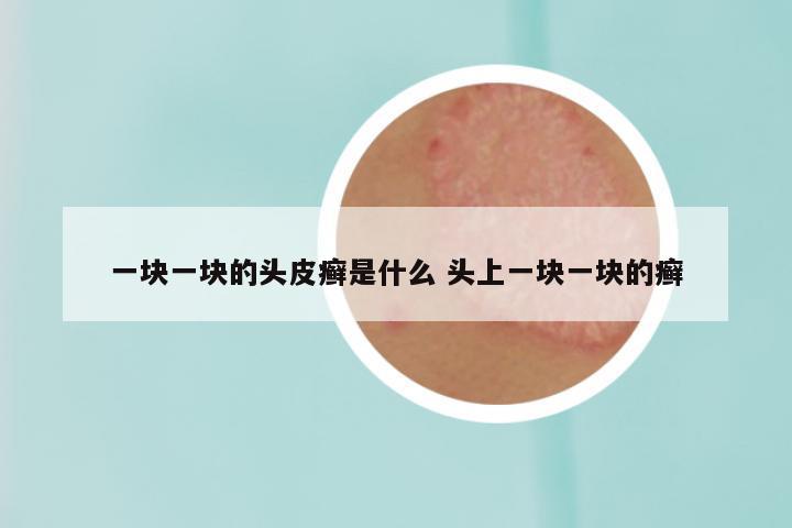 一块一块的头皮癣是什么 头上一块一块的癣
