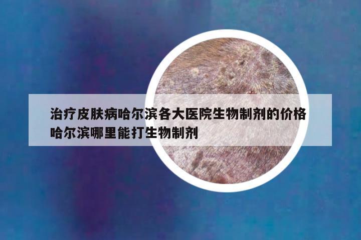治疗皮肤病哈尔滨各大医院生物制剂的价格 哈尔滨哪里能打生物制剂