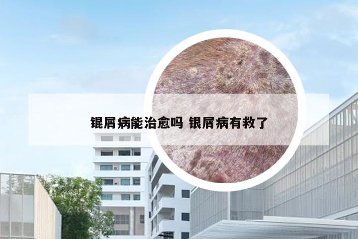 锟屑病能治愈吗 银屑病有救了