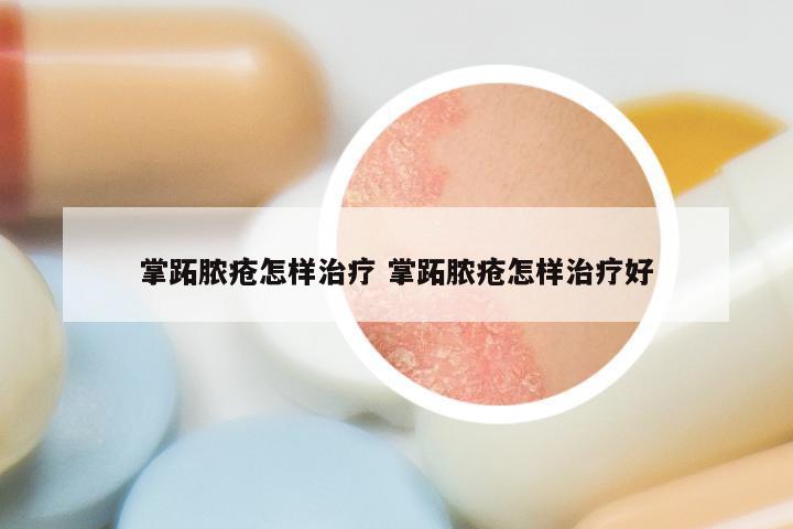 掌跖脓疮怎样治疗 掌跖脓疮怎样治疗好