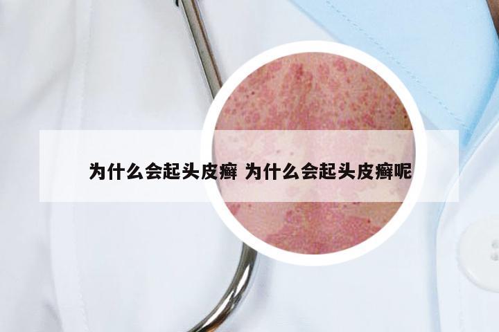 为什么会起头皮癣 为什么会起头皮癣呢