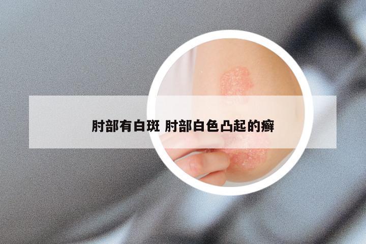 肘部有白斑 肘部白色凸起的癣