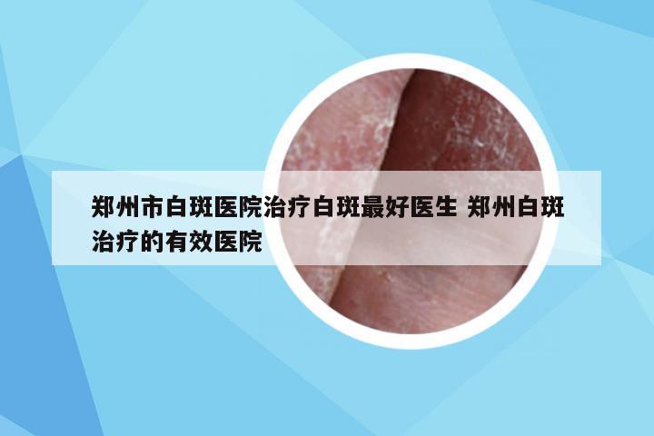 郑州市白斑医院治疗白斑最好医生 郑州白斑治疗的有效医院