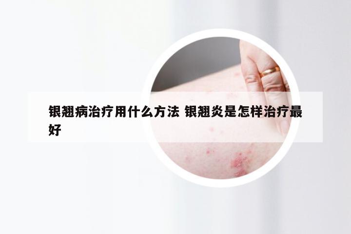 银翘病治疗用什么方法 银翘炎是怎样治疗最好