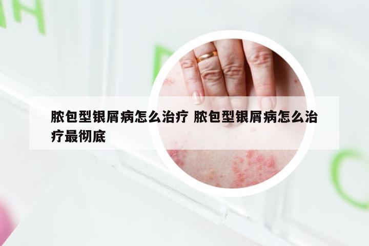 脓包型银屑病怎么治疗 脓包型银屑病怎么治疗最彻底