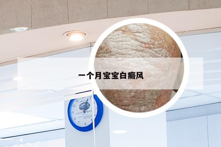 一个月宝宝白癜风