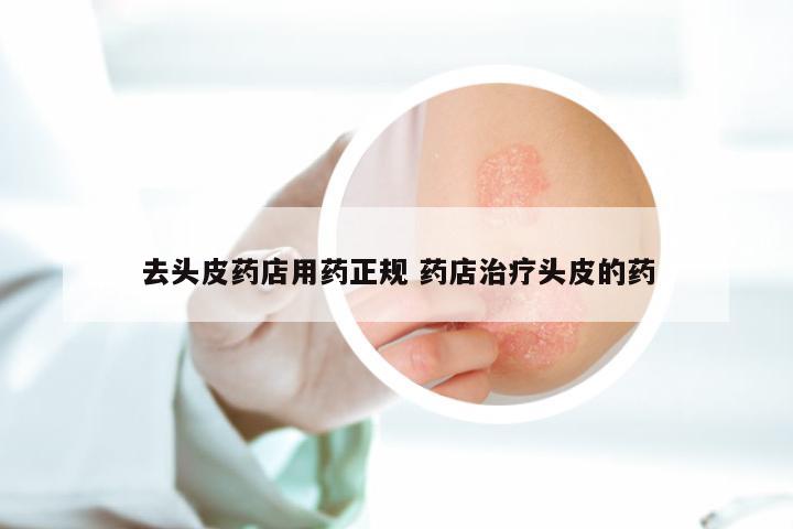 去头皮药店用药正规 药店治疗头皮的药