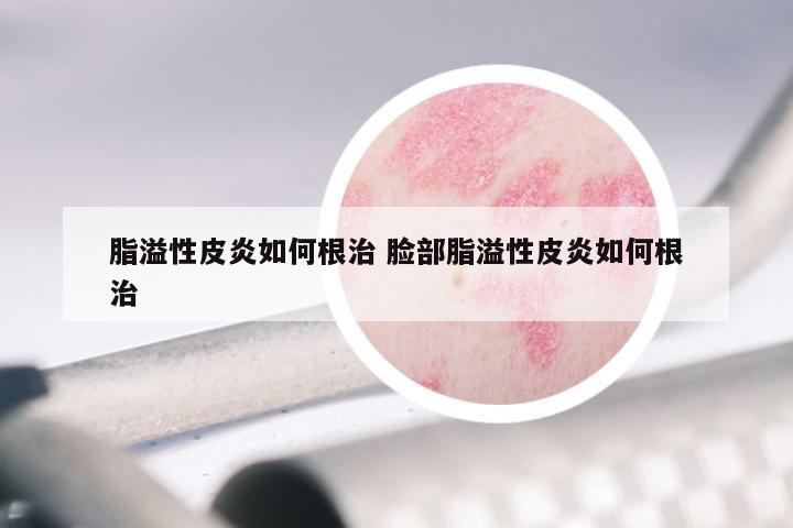 脂溢性皮炎如何根治 脸部脂溢性皮炎如何根治