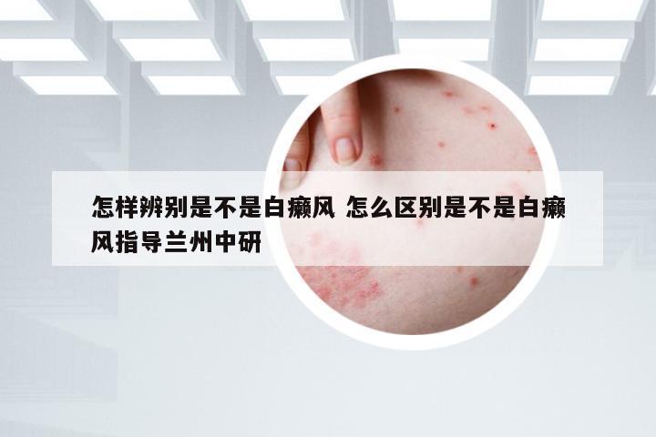怎样辨别是不是白癞风 怎么区别是不是白癞风指导兰州中研