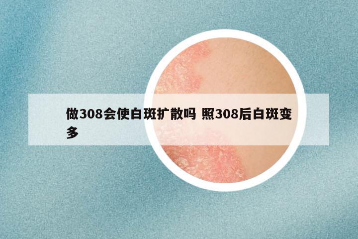 做308会使白斑扩散吗 照308后白斑变多