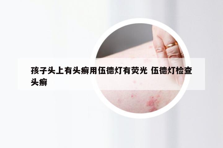 孩子头上有头癣用伍德灯有荧光 伍德灯检查头癣