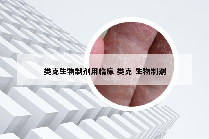 类克生物制剂用临床 类克 生物制剂