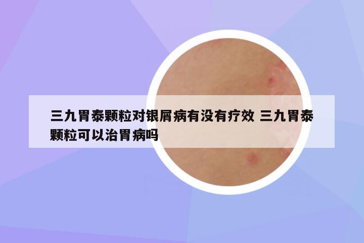 三九胃泰颗粒对银屑病有没有疗效 三九胃泰颗粒可以治胃病吗