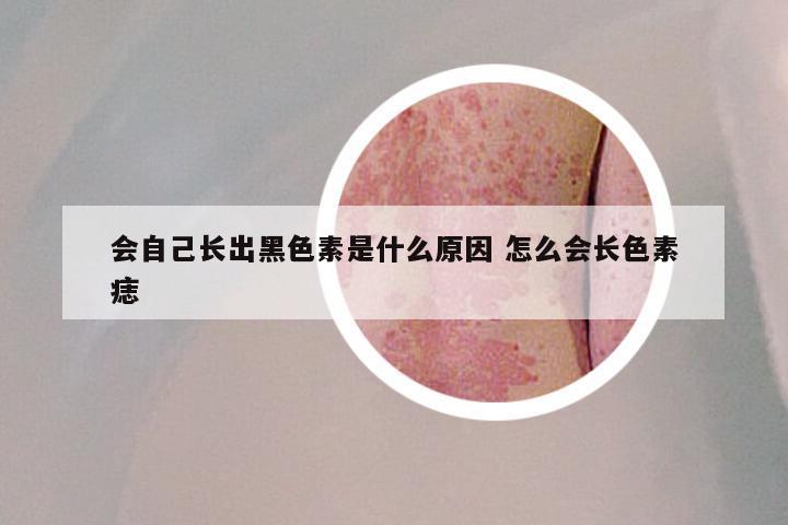 会自己长出黑色素是什么原因 怎么会长色素痣