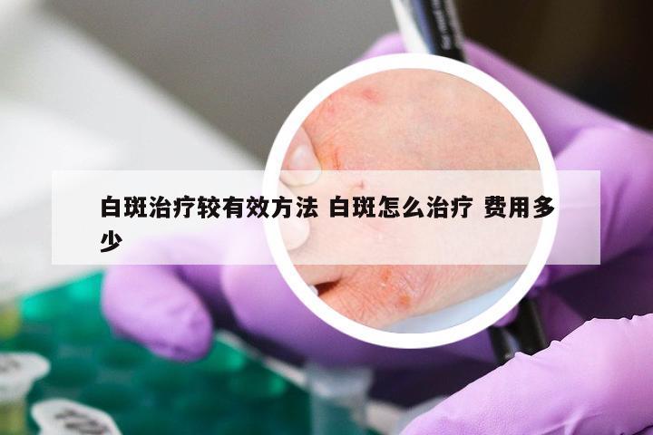 白斑治疗较有效方法 白斑怎么治疗 费用多少